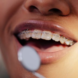 braces-saline