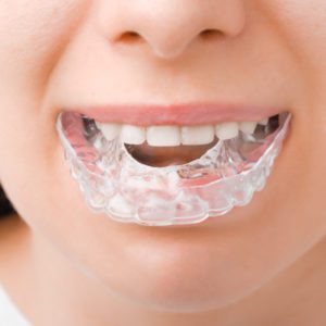 clear-aligners-saline